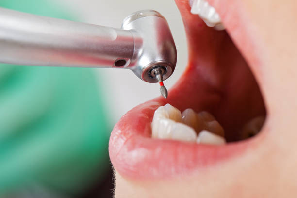 Emergency Dental Filling Replacement in TN